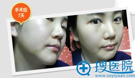 手术后1周了,的变化是脸上的线条。浮肿和淤青都消得很快 手术后1周了,的变化是脸上的线条。浮肿和淤青都消得很快