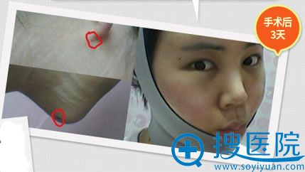 手术后 3天,还没消肿,也有淤青 手术后 3天,还没消肿,也有淤青