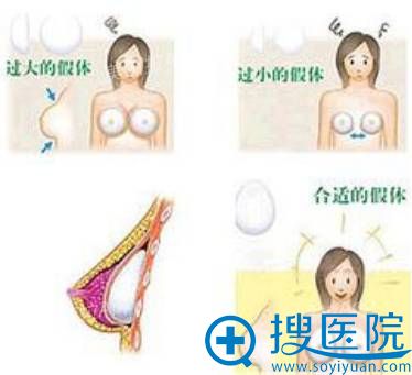 隆胸一定要选择合适的假体 隆胸一定要选择合适的假体