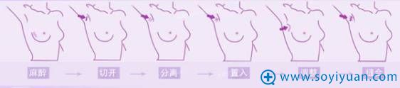 假体隆胸流程 假体隆胸流程