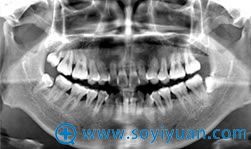 3D CT+口腔全景片使手术更加安全! 3D CT+口腔全景片使手术更加安全!