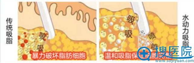 水动力吸脂脂肪移植成活率高达93% 面部填充效果更持久 水动力吸脂脂肪移植成活率高达93% 面部填充效果更持久