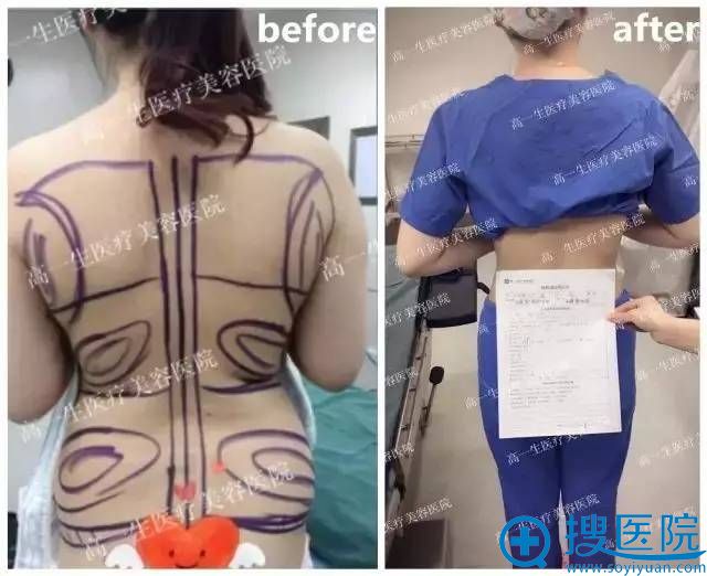 西安高一生水动力吸脂案例 西安高一生水动力吸脂案例