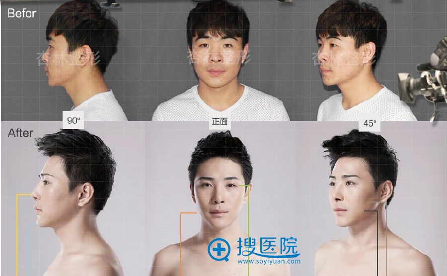 手术前后对比照片,帅吧~ 手术前后对比照片,帅吧~