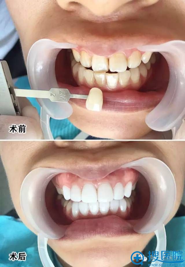 西安高一生美牙瓷贴面真人案例: 西安高一生美牙瓷贴面真人案例:
