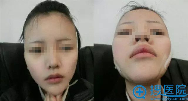 胶带瘦脸效果展示 胶带瘦脸效果展示