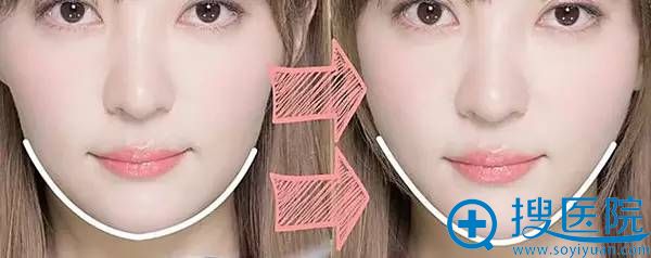 几块钱瘦脸不靠谱 几块钱瘦脸不靠谱