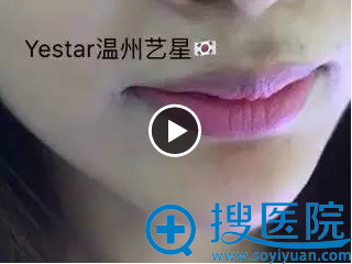 温州艺星垫下巴案例:术后,下巴尖尖的超美哦 温州艺星垫下巴案例:术后,下巴尖尖的超美哦