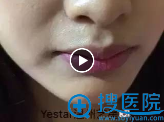 温州艺星垫下巴案例:术前,下巴短平 温州艺星垫下巴案例:术前,下巴短平