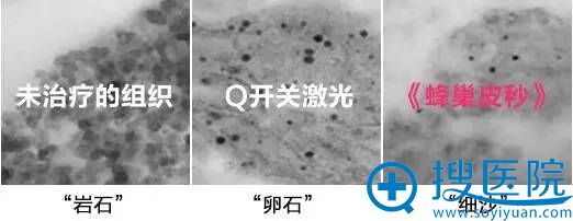 蜂巢皮秒净白肌肤对比图 蜂巢皮秒净白肌肤对比图