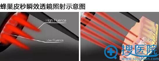 蜂巢皮秒瞬效透镜照射示意图 蜂巢皮秒瞬效透镜照射示意图