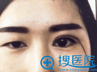 单眼皮双眼皮对比照片 单眼皮双眼皮对比照片