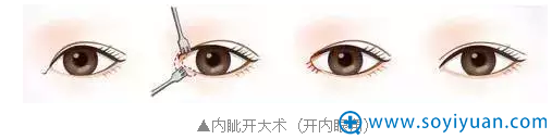 开内眼角手术示意图 开内眼角手术示意图