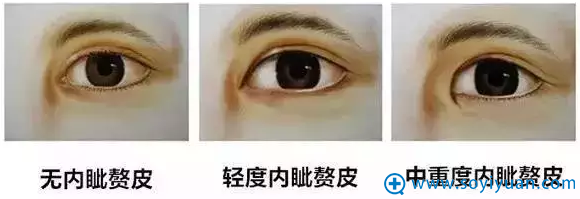 内眦赘皮严重程度 内眦赘皮严重程度