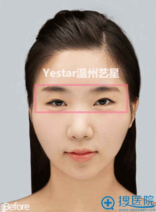 艺星美杜莎综合美眼对比案例之术前效果 艺星美杜莎综合美眼对比案例之术前效果