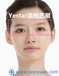 艺星美杜莎综合美眼对比案例之术后效果 艺星美杜莎综合美眼对比案例之术后效果