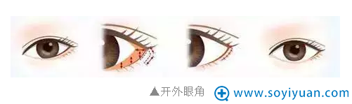 开外眼角手术示意图 开外眼角手术示意图