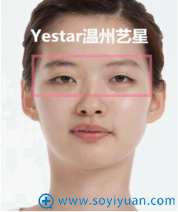 艺星美杜莎综合美眼对比案例之术前效果 艺星美杜莎综合美眼对比案例之术前效果