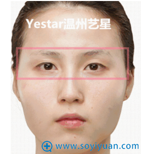 艺星美杜莎综合美眼对比案例之术前效果 艺星美杜莎综合美眼对比案例之术前效果