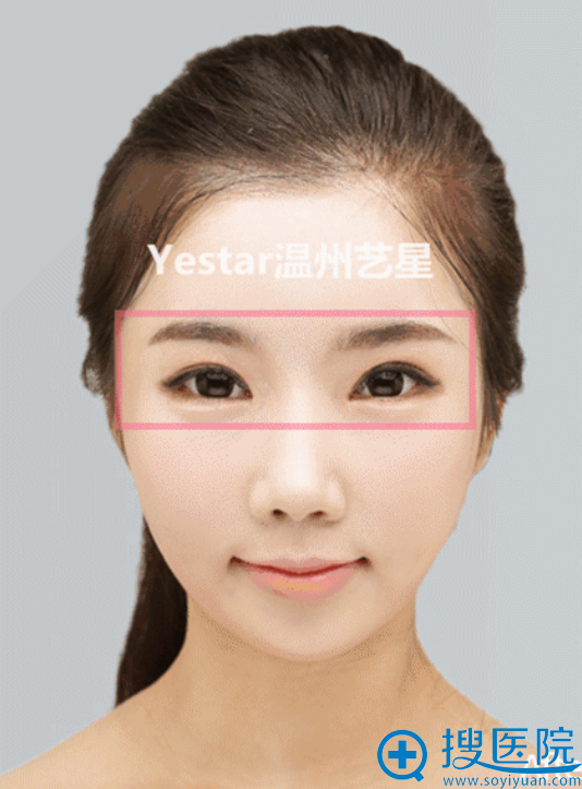 艺星美杜莎综合美眼对比案例之术后效果 艺星美杜莎综合美眼对比案例之术后效果