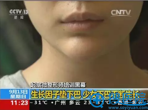生长因子垫下巴 少女下巴不断生长 生长因子垫下巴 少女下巴不断生长