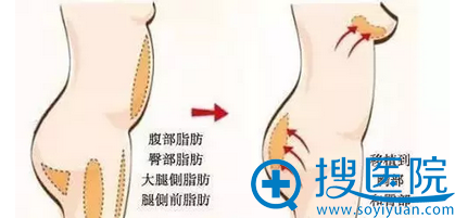 身形不够玲珑的女性脂肪移植对比图 身形不够玲珑的女性脂肪移植对比图