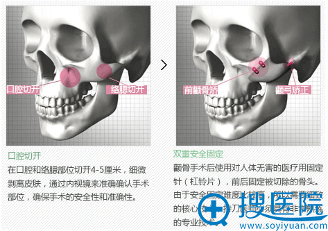 原辰采用口腔切开和双重安全固定所以不会出现皮肤下垂的情况 原辰采用口腔切开和双重安全固定所以不会出现皮肤下垂的情况