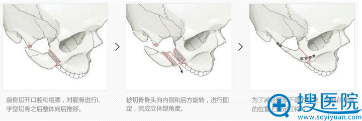 1、针对前颧骨手术过程 1、针对前颧骨手术过程