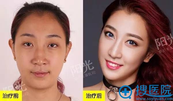 <!--<i data=20240710 data-id=12045></i>-->整形医院双眼皮真人案例3 <!--<i data=20240710 data-id=12045></i>-->整形医院双眼皮真人案例3