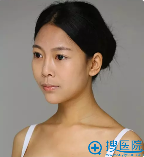 术后一周效果,更有女神范了 术后一周效果,更有女神范了