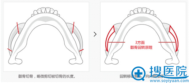 缩减颧弓效果图 缩减颧弓效果图