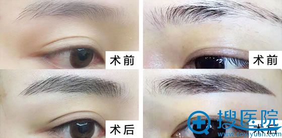 浙江金华华美整形美容医院 韩式半纹眉只要698元!