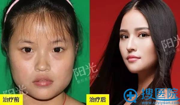 <!--<i data=20240710 data-id=12045></i>-->整形医院双眼皮真人案例1 <!--<i data=20240710 data-id=12045></i>-->整形医院双眼皮真人案例1
