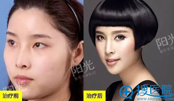 <!--<i data=20240710 data-id=12045></i>-->整形医院双眼皮真人案例4 <!--<i data=20240710 data-id=12045></i>-->整形医院双眼皮真人案例4