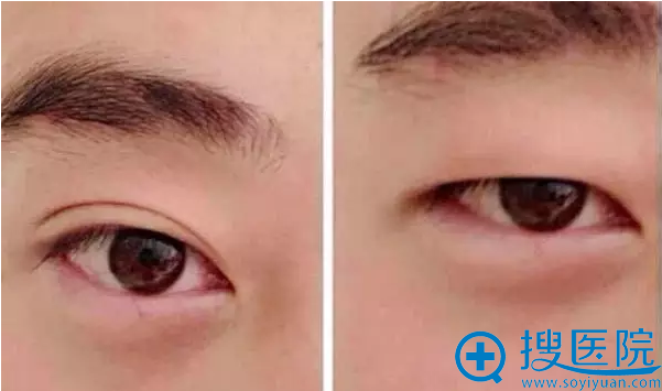 双眼皮整形案例 双眼皮整形案例