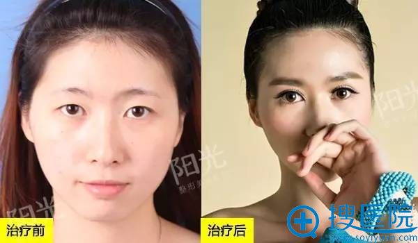 <!--<i data=20240710 data-id=12045></i>-->整形医院双眼皮真人案例2 <!--<i data=20240710 data-id=12045></i>-->整形医院双眼皮真人案例2