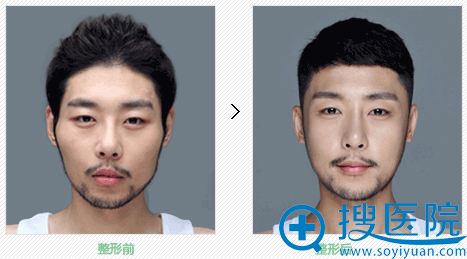 颧骨内推效果图 颧骨内推效果图