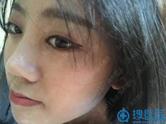 馨馨隆鼻术后照片 馨馨隆鼻术后照片