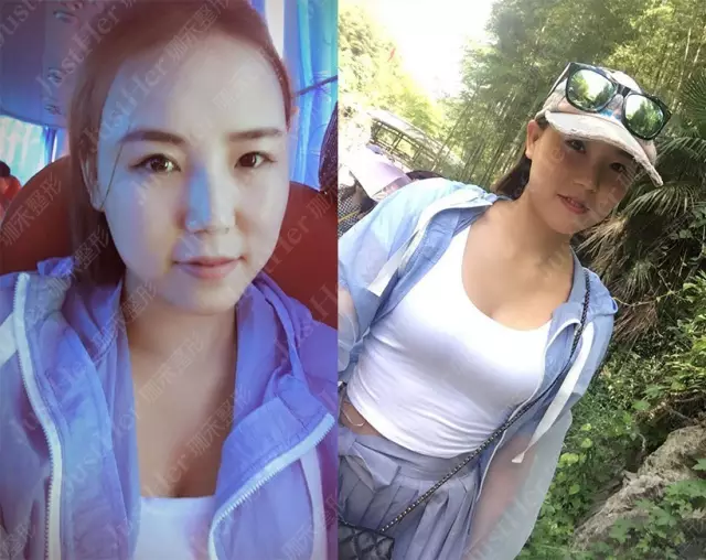 燕子鼻整形术后生活照 燕子鼻整形术后生活照