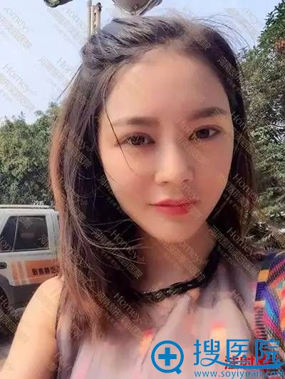 玻尿酸面部填充术后生活自拍照 玻尿酸面部填充术后生活自拍照