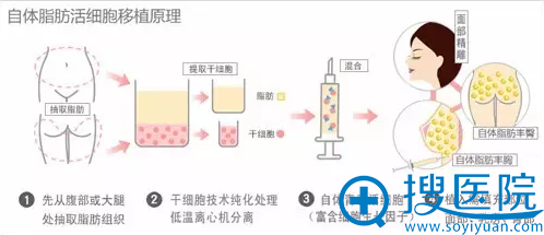 自体脂肪活细胞移植原理 自体脂肪活细胞移植原理