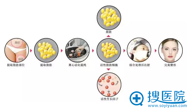 自体脂肪填充全无"排异"的后顾之忧 自体脂肪填充全无"排异"的后顾之忧