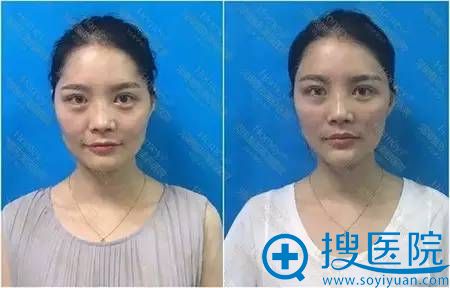 玻尿酸面部填充术后对比照 玻尿酸面部填充术后对比照