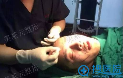 医生开始面部设计,为脂肪填充做准备 医生开始面部设计,为脂肪填充做准备