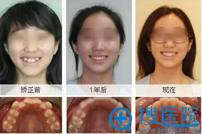 牙齿整形怎么样 牙齿矫正真的能改变脸型吗