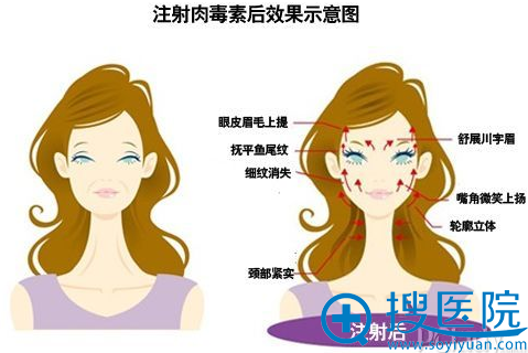 宜春华美精细除皱针 单部位祛皱仅需398元