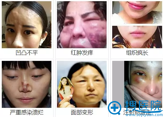 奥美定会造成:凹凸不平、红肿发痒、组织疯长、严重感染溃烂、面部变形、注射物游走等危害 奥美定会造成:凹凸不平、红肿发痒、组织疯长、严重感染溃烂、面部变形、注射物游走等危害
