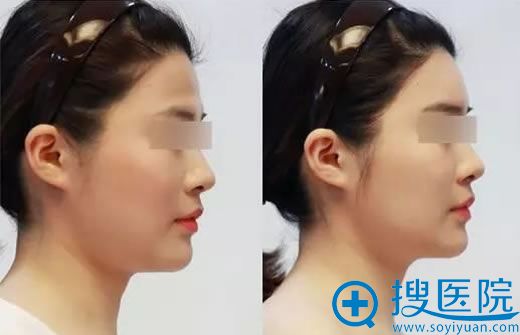 洛阳华美医疗美容医院玻尿酸丰额头.jpg 洛阳华美医疗美容医院玻尿酸丰额头.jpg