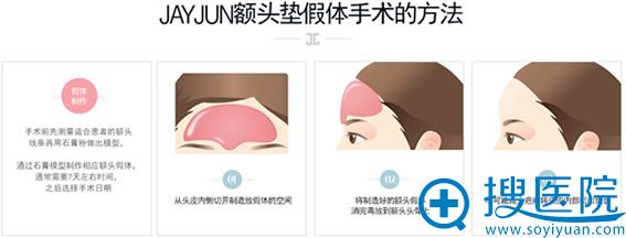 假体垫额头的方法 假体垫额头的方法
