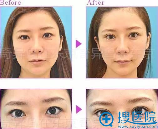 保志名胜埋线双眼皮案例六 保志名胜埋线双眼皮案例六